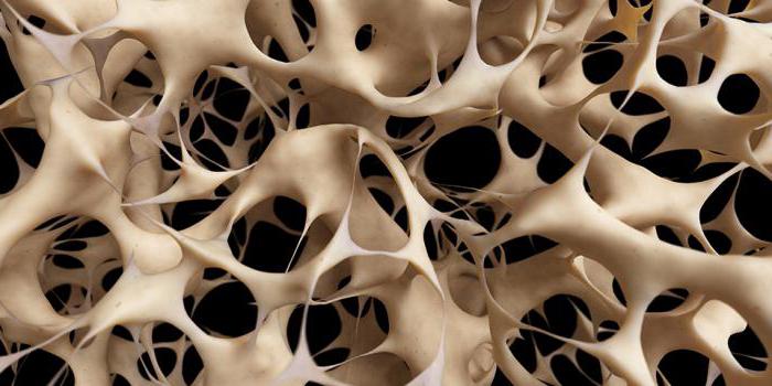 osteoporosis, amelyet az orvos gyógyít